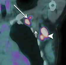 PET/CT image show FDG uptake also in asilla